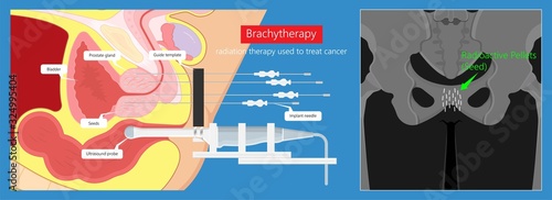 Brachytherapy procedure radioactive material medical treatment therapy