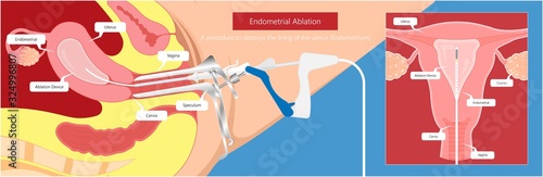 Endometrial ablation surgical uterus procedure