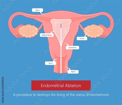 Endometrial ablation surgical uterus procedure photo