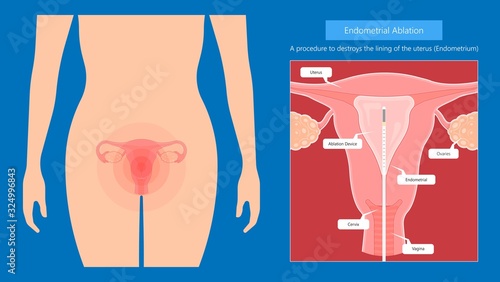 Endometrial ablation surgical uterus procedure