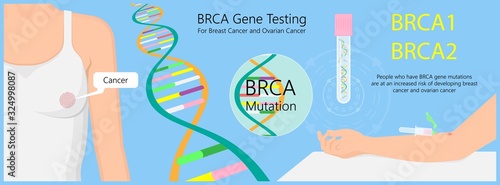 BRCA gene test for breast and ovarian cancer