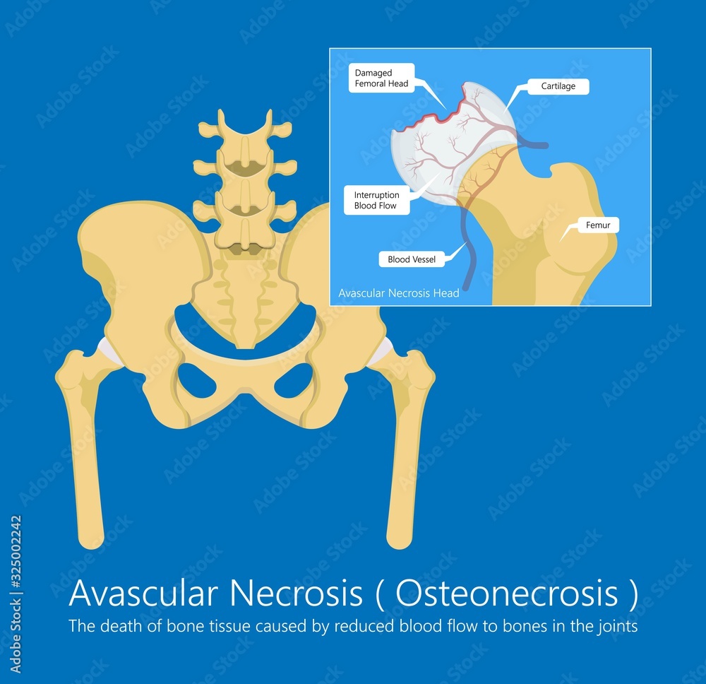 Avascular necrosis bone tissue disease Stock Vector | Adobe Stock