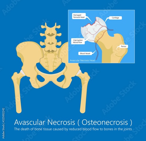 Avascular necrosis bone tissue disease