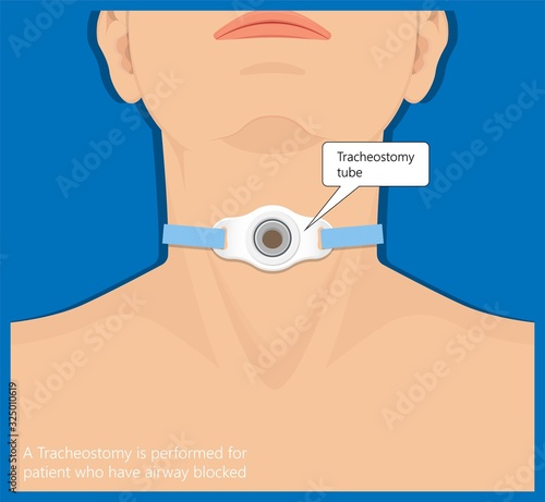 Tracheostomy tube medical procedure neck windpipe emergency breathing
