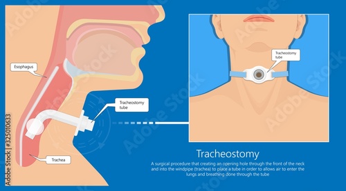 Tracheostomy tube medical procedure neck windpipe emergency breathing photo