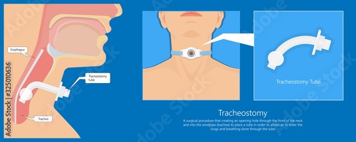 Tracheostomy tube medical procedure neck windpipe emergency breathing