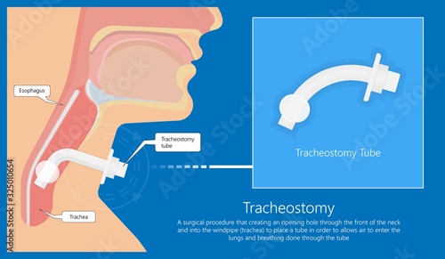 Tracheostomy tube medical procedure neck windpipe emergency breathing