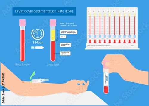 Erythrocyte Sedimentation Rate Test (ESR) Test blood diagnose inflammation disease