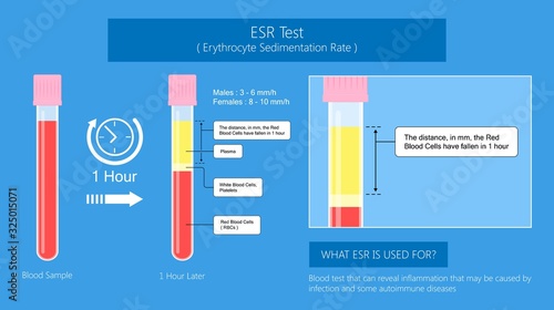 Erythrocyte Sedimentation Rate Test (ESR) Test blood diagnose inflammation disease
