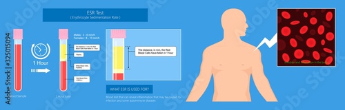 Erythrocyte Sedimentation Rate Test (ESR) Test blood diagnose inflammation disease
