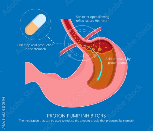 Proton pump inhibitors drugs medication for treatment stomach acid Gastroesophageal reflux disease (GERD)