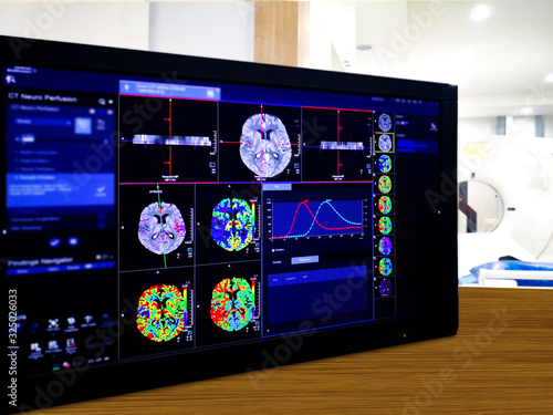 Brain Perfusion or CT scan of Blood flow in the brain 3d rendering image on the screen with CT Scan room. photo