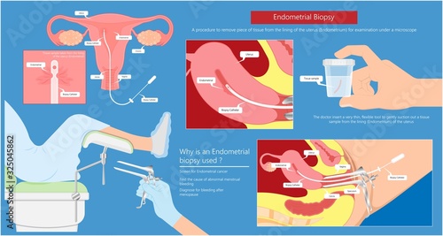 endometrial biopsy examination uterus procedure