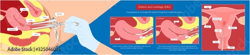 endometrial biopsy examination uterus procedure