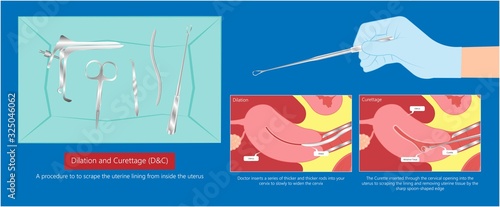 endometrial biopsy examination uterus procedure