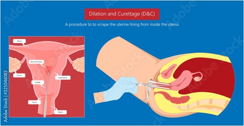 endometrial biopsy examination uterus procedure