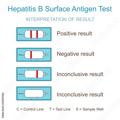 Hepatitis B virus test.Hepatitis B interpretation of result.Hepatitis B surface antigen cassette test.