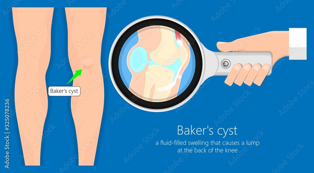 Baker's cyst (Popliteal) swelling knee joint inflammation arthritis