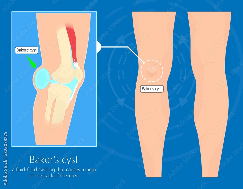 Baker's cyst (Popliteal) swelling knee joint inflammation arthritis