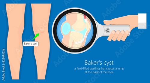 Baker's cyst (Popliteal) swelling knee joint  inflammation arthritis gout