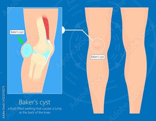 Baker's cyst (Popliteal) swelling knee joint  inflammation arthritis gout