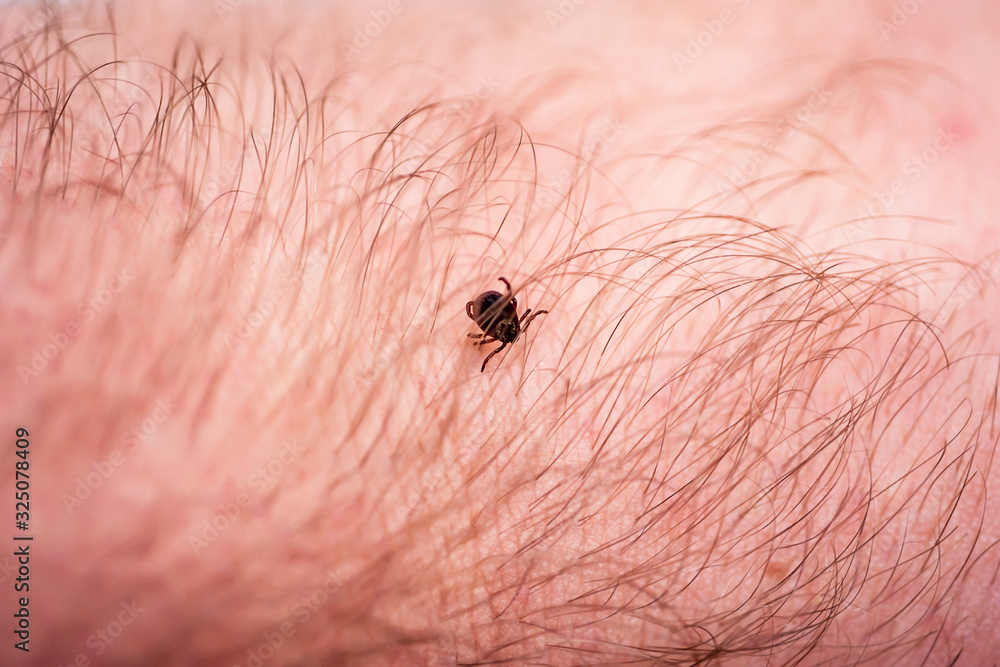 Lyme Disease Infected Tick Insect Crawling On Skin Encephalitis Virus