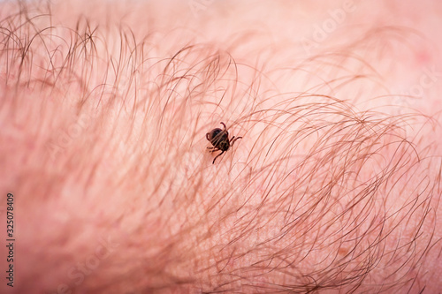 Lyme Disease Infected Tick Insect Crawling on Skin. Encephalitis Virus or Lyme Borreliosis Disease Infectious Dermacentor Tick Arachnid Parasite Macro. photo