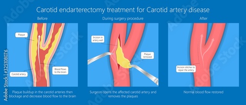 Coronary artery disease CAD diagnosis treatment