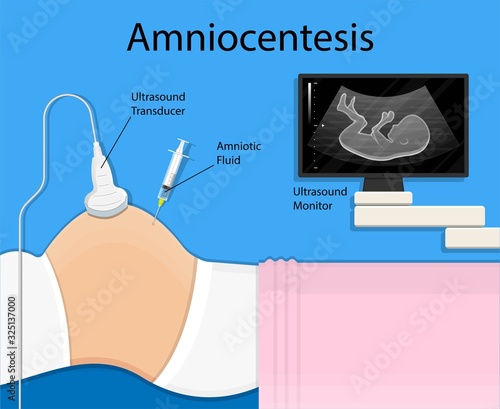 Amniocentesis diagnostic test treat LAB analysis chromosome DNA gene abnormal