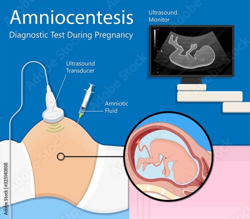 Amniocentesis diagnostic test treat LAB analysis chromosome DNA gene abnormal