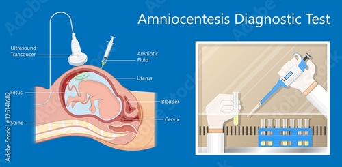 Amniocentesis diagnostic test treat LAB analysis chromosome DNA gene abnormal