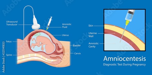 Amniocentesis diagnostic test treat LAB analysis chromosome DNA gene abnormal