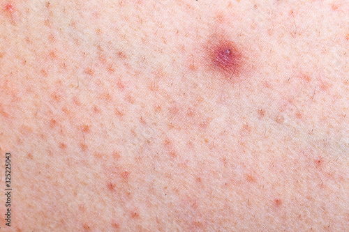 A close up shot of an allergic skin