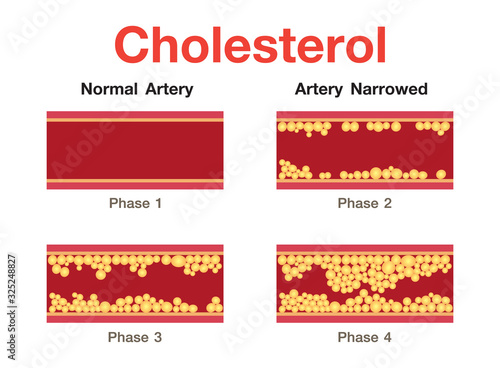 Cholesterol in artery, health risk , vector design