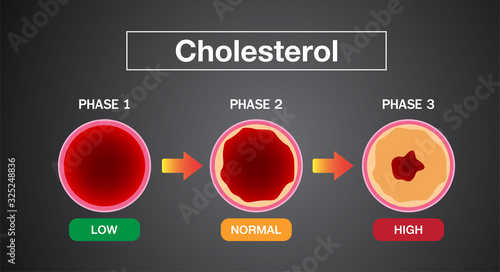 Cholesterol in artery, health risk , vector design