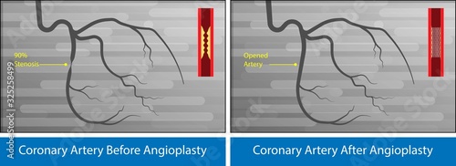 Cardiac catheter ablation Atrial fibrillation minimally invasive procedure