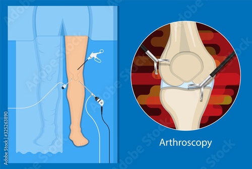 Arthroscopy medical treatment surgery keyhole surgical treat endoscope