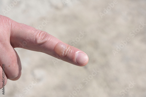 Big bublle Blister on man finger on background, Isolated © Jantira