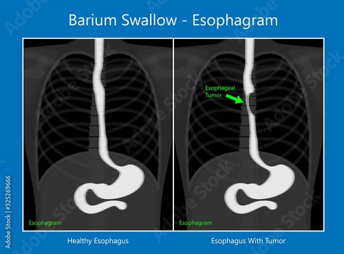 Intravenous pyelogram IVP exam diagnose treat ionizing symptom
