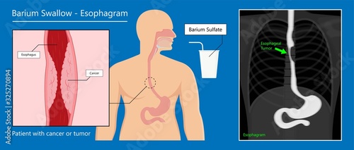 Intravenous pyelogram IVP exam diagnose treat ionizing symptom