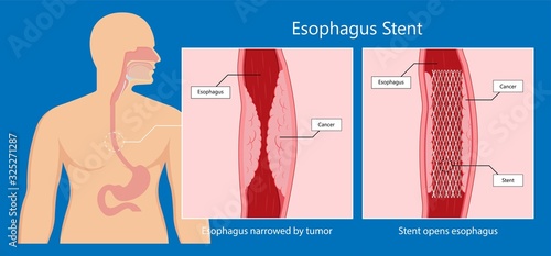 Intravenous pyelogram IVP exam diagnose treat ionizing symptom