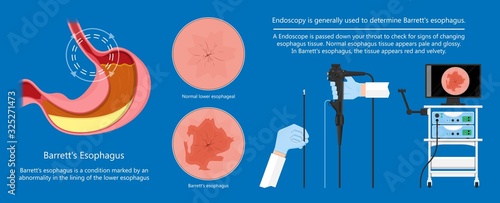 Barrett's esophagus acid lower risk cells dysplasia treat diagnosis