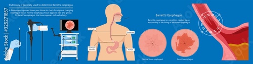 Barrett's esophagus acid lower risk cells dysplasia treat diagnosis