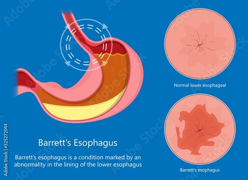 Barrett's esophagus acid lower risk cells dysplasia treat diagnosis photo