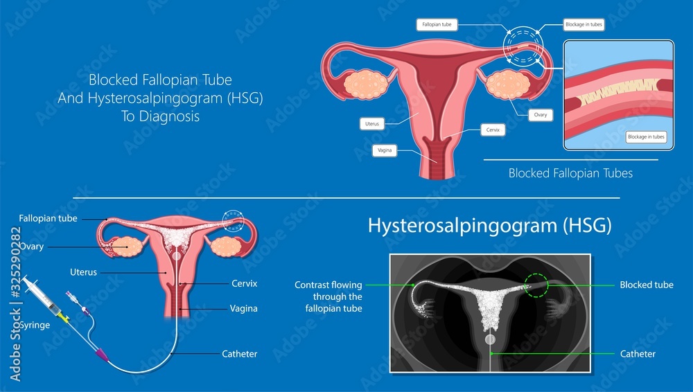 Vetor de Hysterosalpingogram HSG Test Blocked Fallopian Tubes diagnose