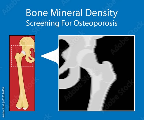 Bone mineral density BMD osteoporosis dual energy X-ray absorptionmetry adult disease equipment medical clinic central DXA pain radiography hospital fragility risk examine