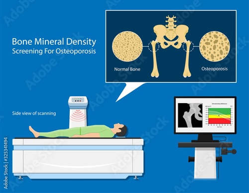 Bone mineral density BMD osteoporosis dual energy X-ray absorptionmetry adult disease equipment medical clinic central DXA pain radiography hospital fragility risk examine