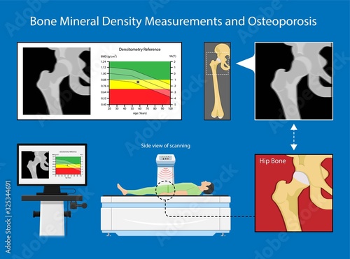 Bone mineral density BMD osteoporosis dual energy X-ray absorptionmetry adult disease equipment medical clinic central DXA pain radiography hospital fragility risk examine