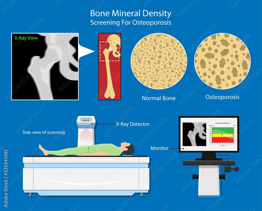 Bone Mineral Density BMD Osteoporosis Dual Energy X ray Absorptionmetry bone-mineral-density-bmd-osteoporosis-dual-energy-x-ray-absorptionmetry
