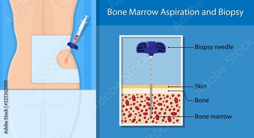 Bone biopsy medical marrow harvest stem cell transplants aspiration specimen cancer procedure sample test treatment diagnosis anemia blood cell lab